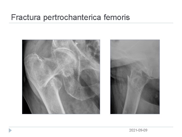 Fractura pertrochanterica femoris 2021 09 09 