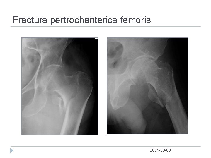 Fractura pertrochanterica femoris 2021 09 09 