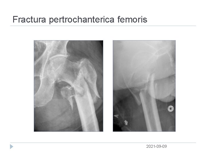 Fractura pertrochanterica femoris 2021 09 09 