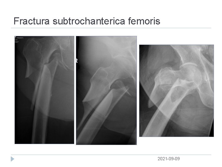 Fractura subtrochanterica femoris 2021 09 09 
