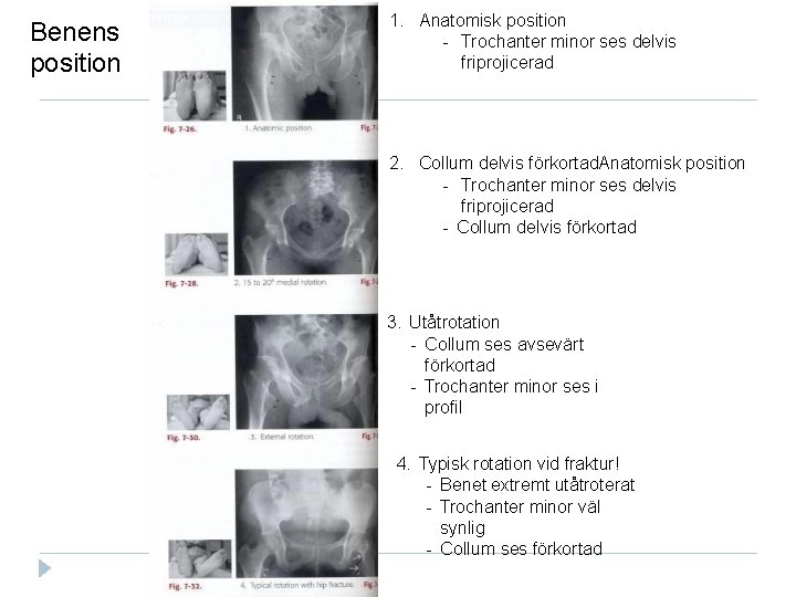 Benens position 1. Anatomisk position Trochanter minor ses delvis friprojicerad 2. Collum delvis förkortad.