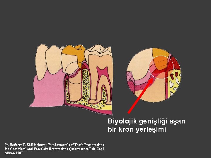 Biyolojik genişliği aşan bir kron yerleşimi Jr. Herbert T. Shillingburg : Fundamentals of Tooth