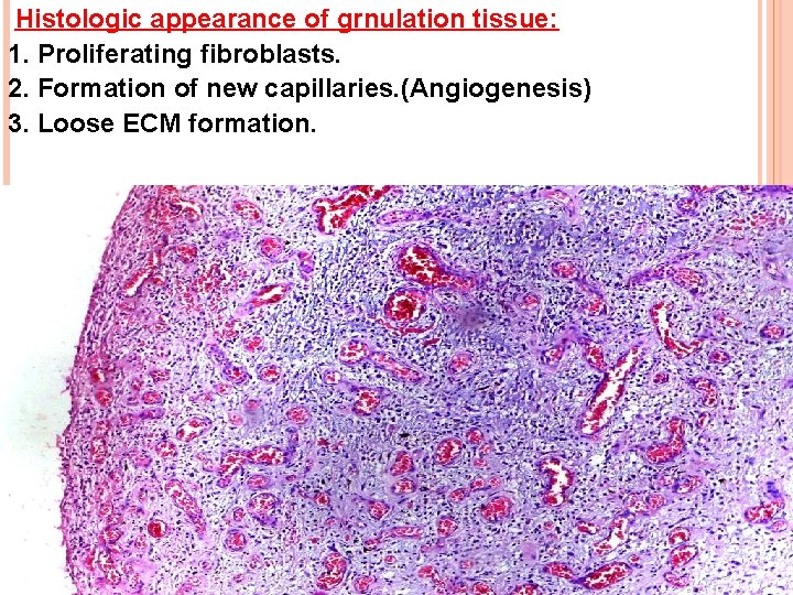 Histologic appearance of grnulation tissue: 1. Proliferating fibroblasts. 2. Formation of new capillaries. (Angiogenesis)