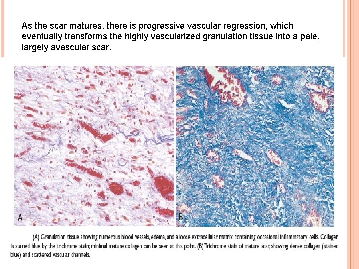 As the scar matures, there is progressive vascular regression, which eventually transforms the highly