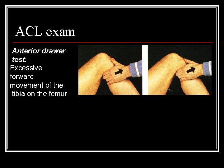 ACL exam Anterior drawer test: test Excessive forward movement of the tibia on the