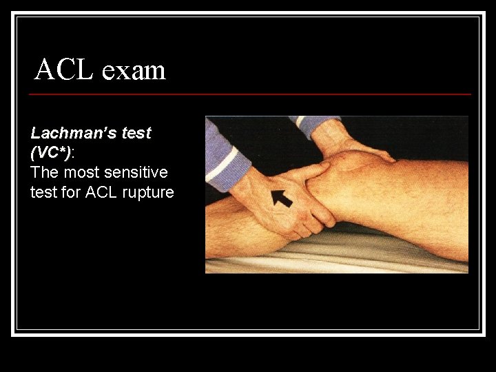 ACL exam Lachman’s test (VC*): (VC*) The most sensitive test for ACL rupture 