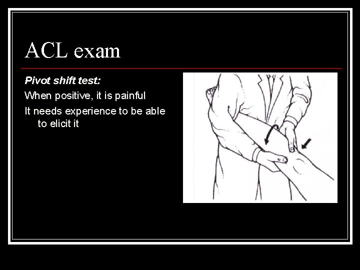 ACL exam Pivot shift test: When positive, it is painful It needs experience to
