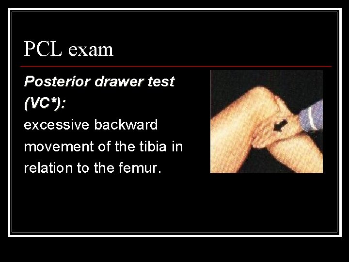 PCL exam Posterior drawer test (VC*): excessive backward movement of the tibia in relation
