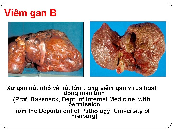 Viêm gan B Xơ gan nốt nhỏ và nốt lớn trong viêm gan virus