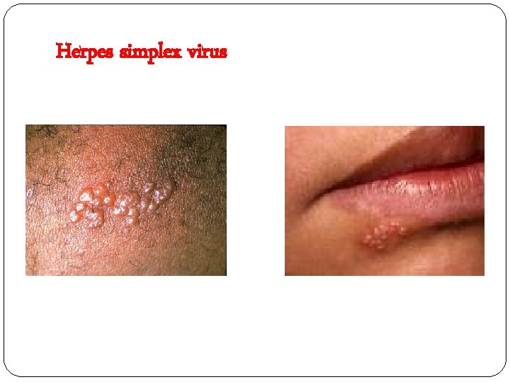 Herpes simplex virus 