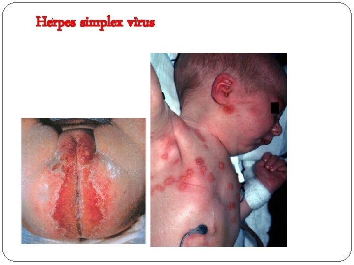 Herpes simplex virus 