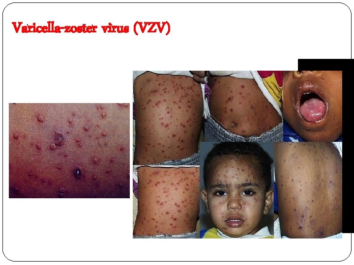 Varicella-zoster virus (VZV) 