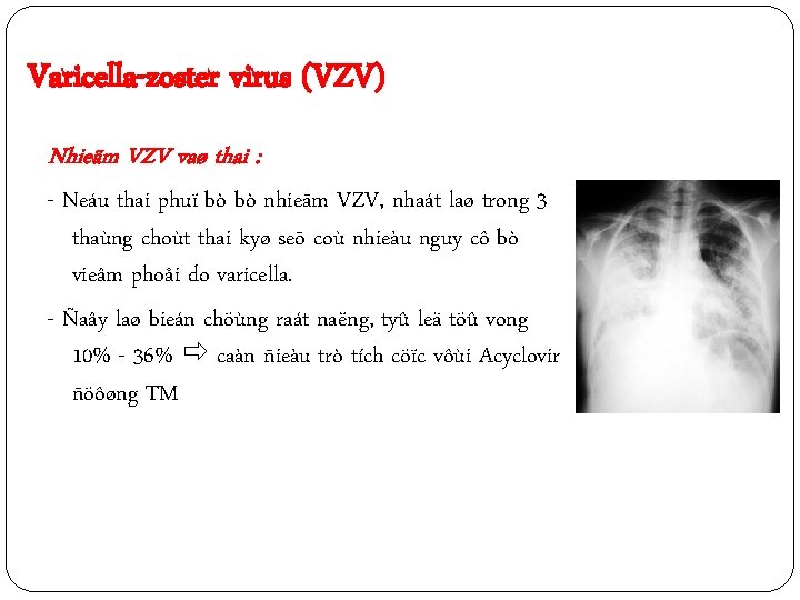 Varicella-zoster virus (VZV) Nhieãm VZV vaø thai : - Neáu thai phuï bò bò