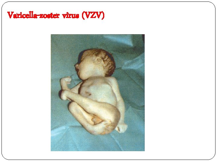 Varicella-zoster virus (VZV) 