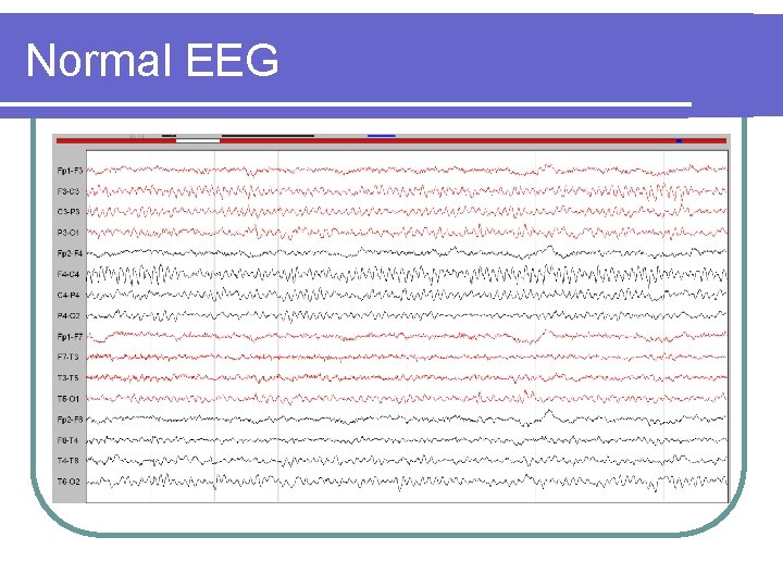 Normal EEG 
