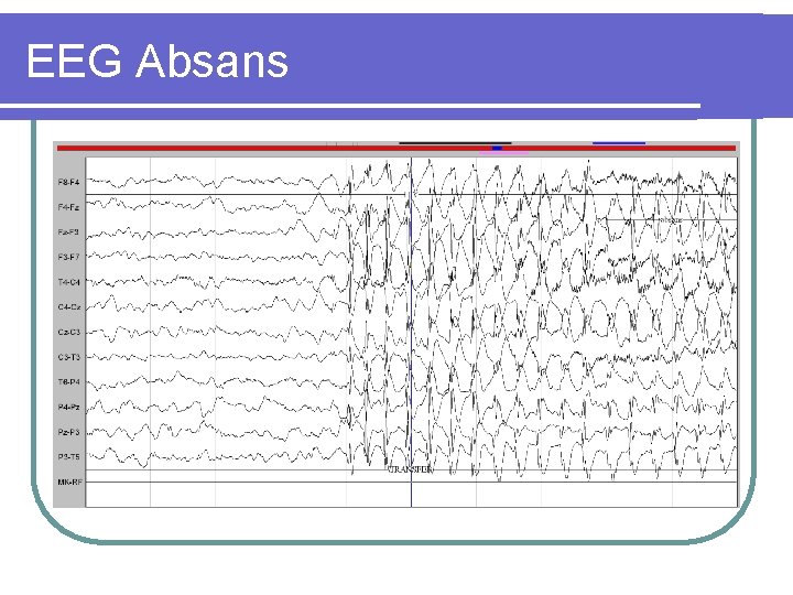 EEG Absans 