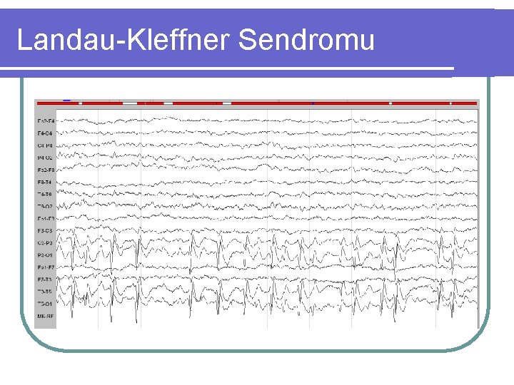 Landau-Kleffner Sendromu 