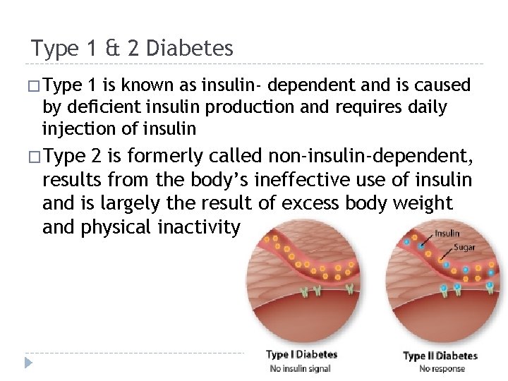 Type 1 & 2 Diabetes � Type 1 is known as insulin- dependent and
