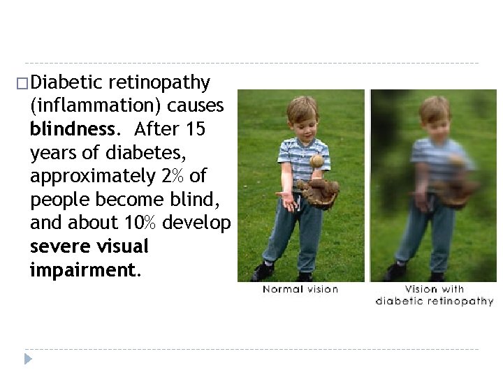 �Diabetic retinopathy (inflammation) causes blindness. After 15 years of diabetes, approximately 2% of people