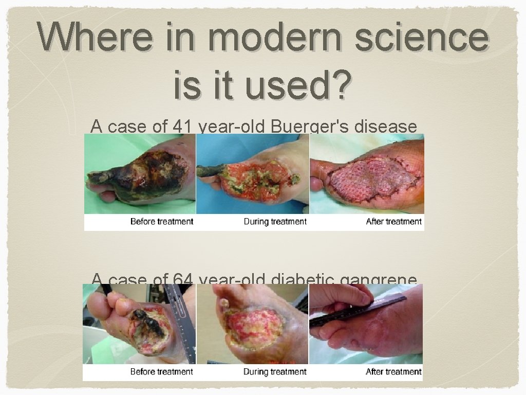 Where in modern science is it used? A case of 41 year-old Buerger's disease