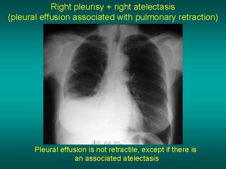 Right pleurisy + right atelectasis (pleural effusion associated with pulmonary retraction) Pleural effusion is