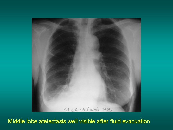 Middle lobe atelectasis well visible after fluid evacuation 