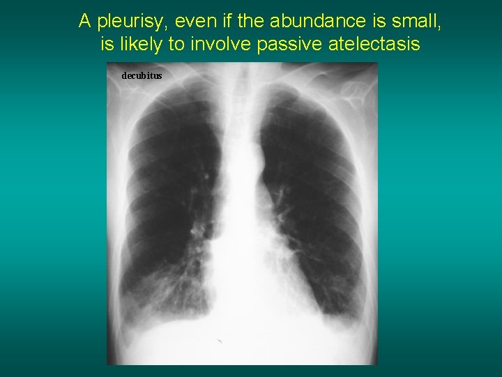 A pleurisy, even if the abundance is small, is likely to involve passive atelectasis