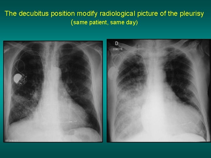 The decubitus position modify radiological picture of the pleurisy (same patient, same day) 