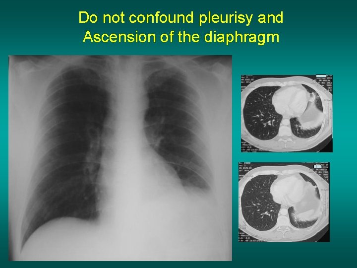 Do not confound pleurisy and Ascension of the diaphragm 