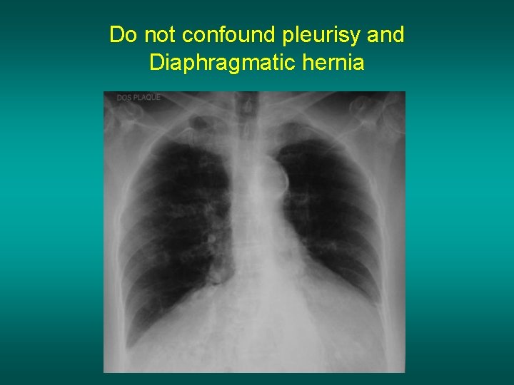 Do not confound pleurisy and Diaphragmatic hernia 