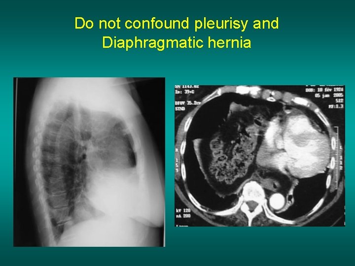 Do not confound pleurisy and Diaphragmatic hernia 