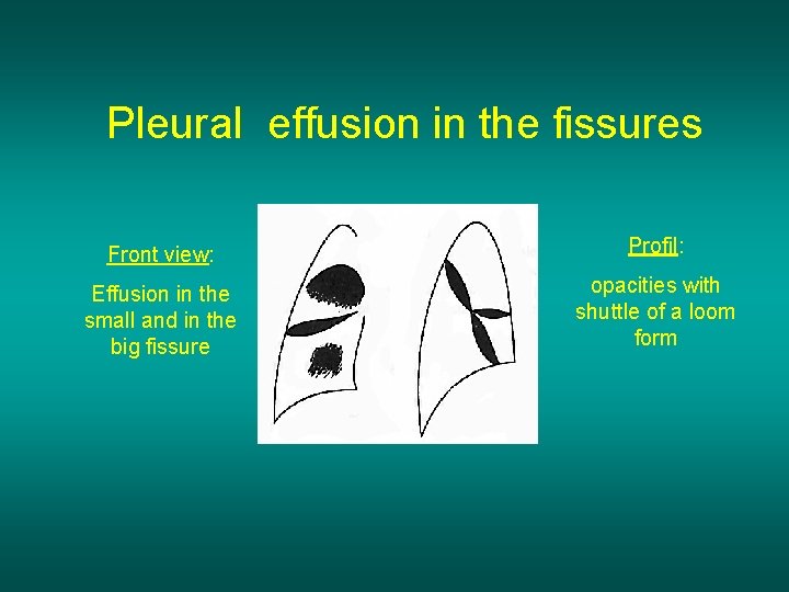 Pleural effusion in the fissures Front view: Profil: Effusion in the small and in