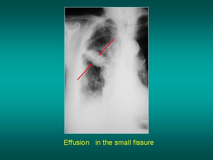 Effusion in the small fissure 