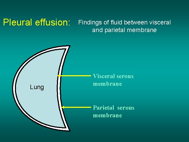 Pleural effusion: Lung Findings of fluid between visceral and parietal membrane Visceral serous membrane
