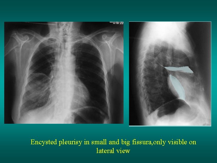 Encysted pleurisy in small and big fissura, only visible on lateral view 