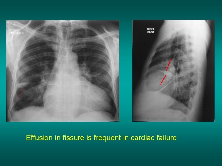 Effusion in fissure is frequent in cardiac failure 