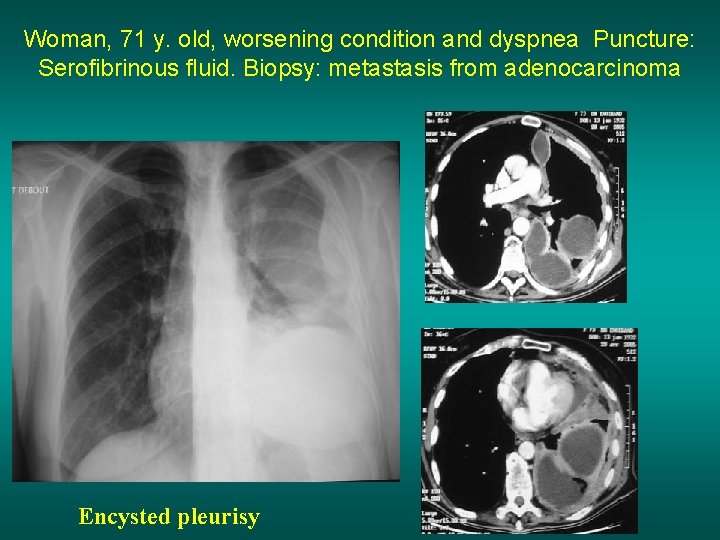 Woman, 71 y. old, worsening condition and dyspnea Puncture: Serofibrinous fluid. Biopsy: metastasis from