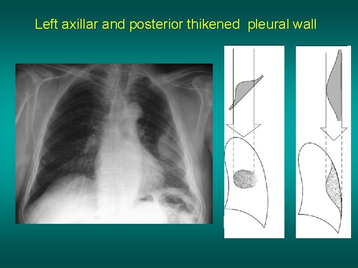 Left axillar and posterior thikened pleural wall 