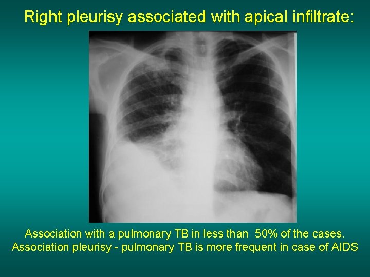 Right pleurisy associated with apical infiltrate: Association with a pulmonary TB in less than