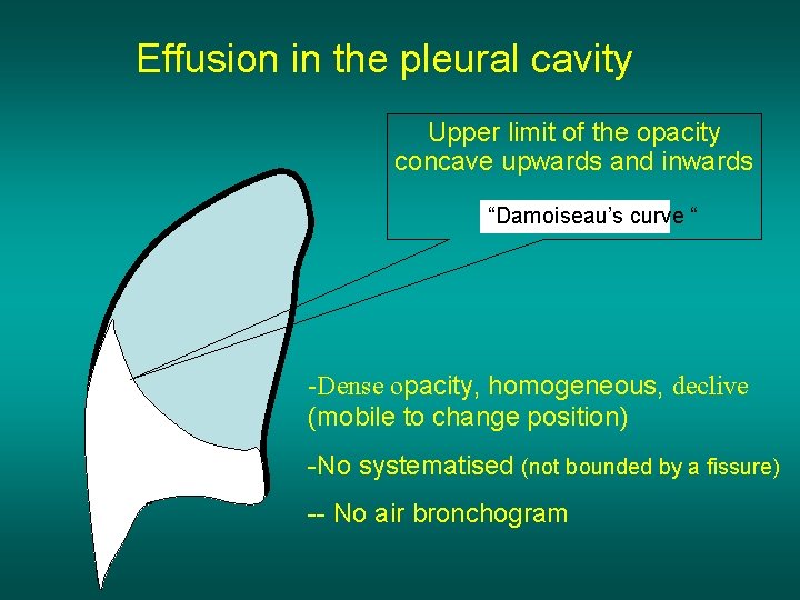 Effusion in the pleural cavity Upper limit of the opacity concave upwards and inwards