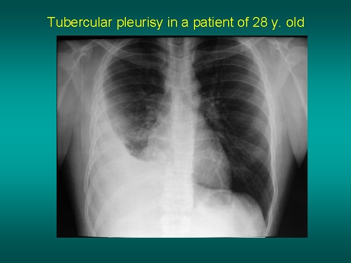 Tubercular pleurisy in a patient of 28 y. old 