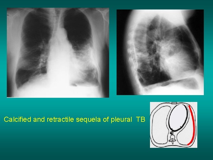 Calcified and retractile sequela of pleural TB 