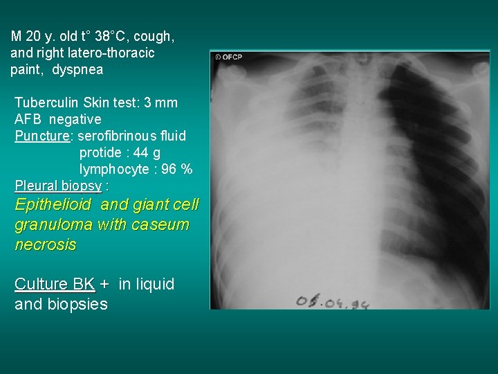 M 20 y. old t° 38°C, cough, and right latero-thoracic paint, dyspnea Tuberculin Skin