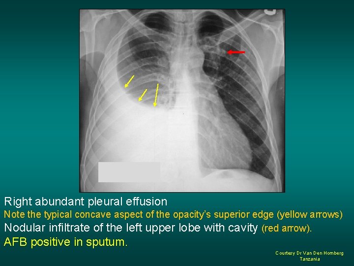 Right abundant pleural effusion Note the typical concave aspect of the opacity’s superior edge