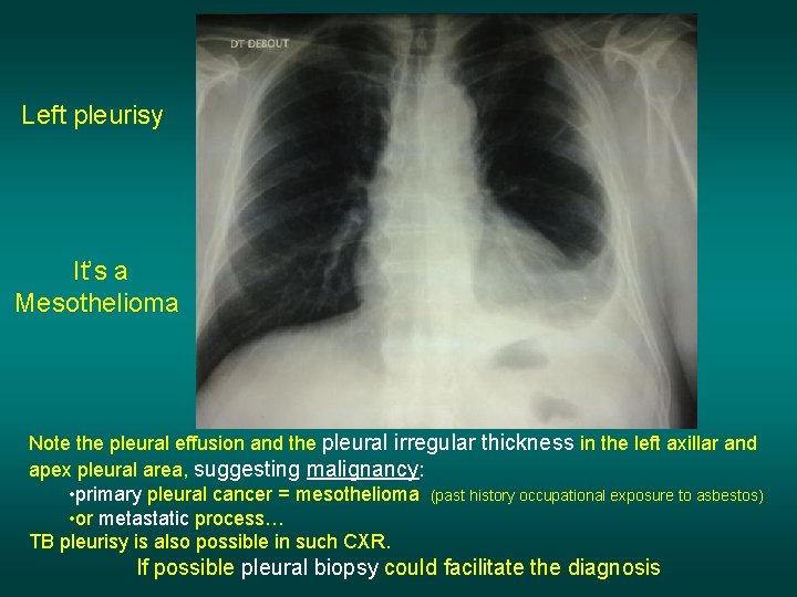 Left pleurisy It’s a Mesothelioma Note the pleural effusion and the pleural irregular thickness