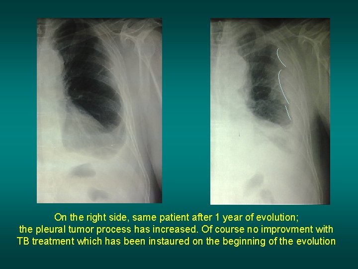 On the right side, same patient after 1 year of evolution; the pleural tumor