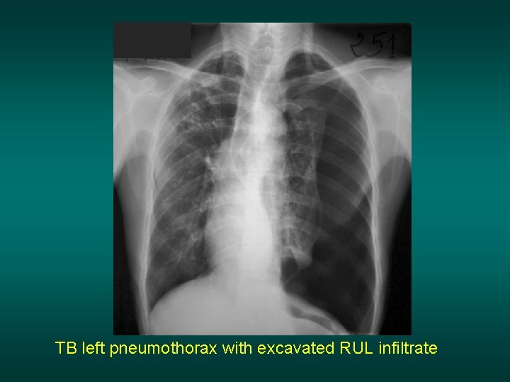 TB left pneumothorax with excavated RUL infiltrate 