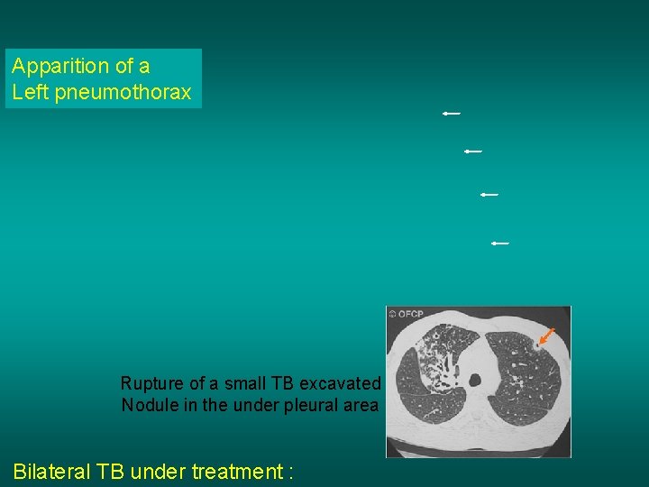 Apparition of a Left pneumothorax Rupture of a small TB excavated Nodule in the