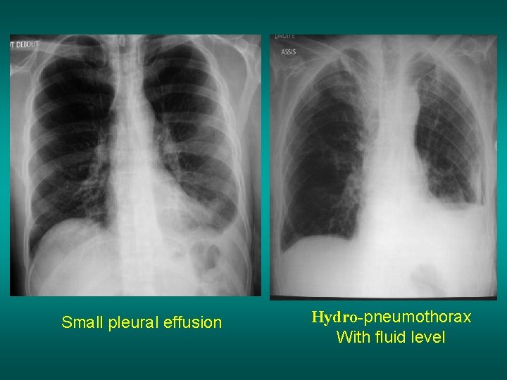 Small pleural effusion Hydro-pneumothorax With fluid level 
