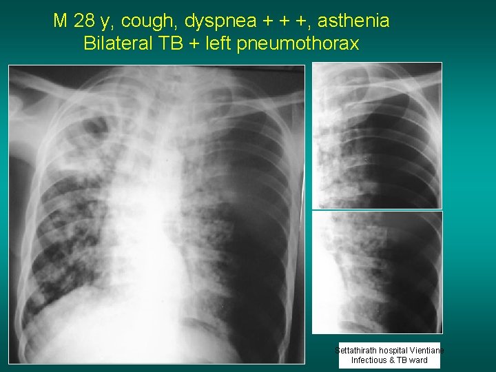 M 28 y, cough, dyspnea + + +, asthenia Bilateral TB + left pneumothorax